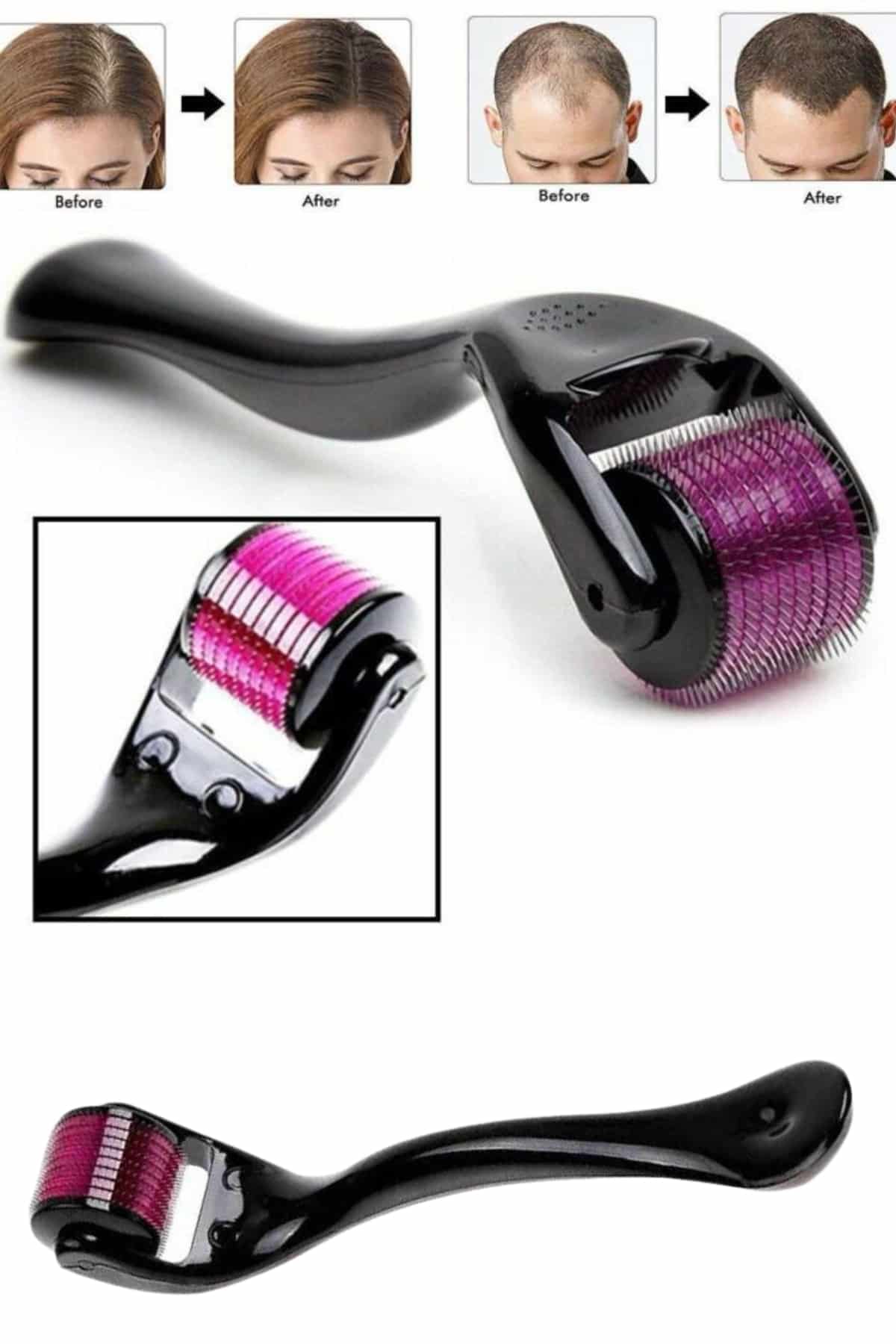 Derma Roller Titanyum Uçlu 540 İğneli 1 Mm Saç Sakal Çıkarma Ve Cilt Bakım Masaj Aleti - Görsel 2